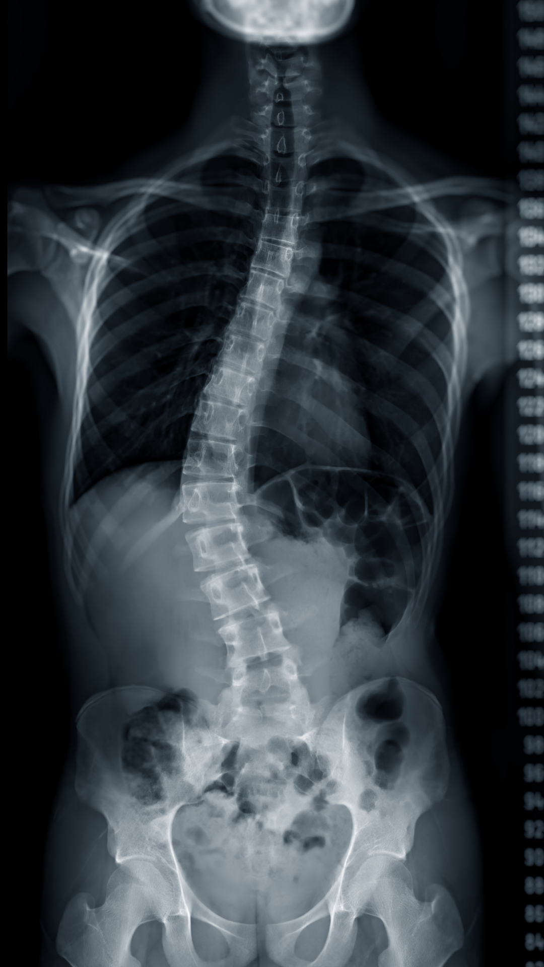 X-ray showing a sideways curvature of the spine
