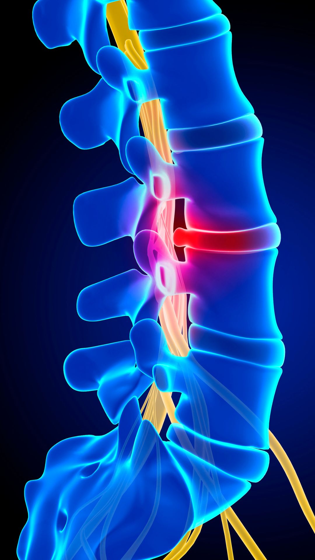 Illustration of a bulging spinal disc pressing on a nerve